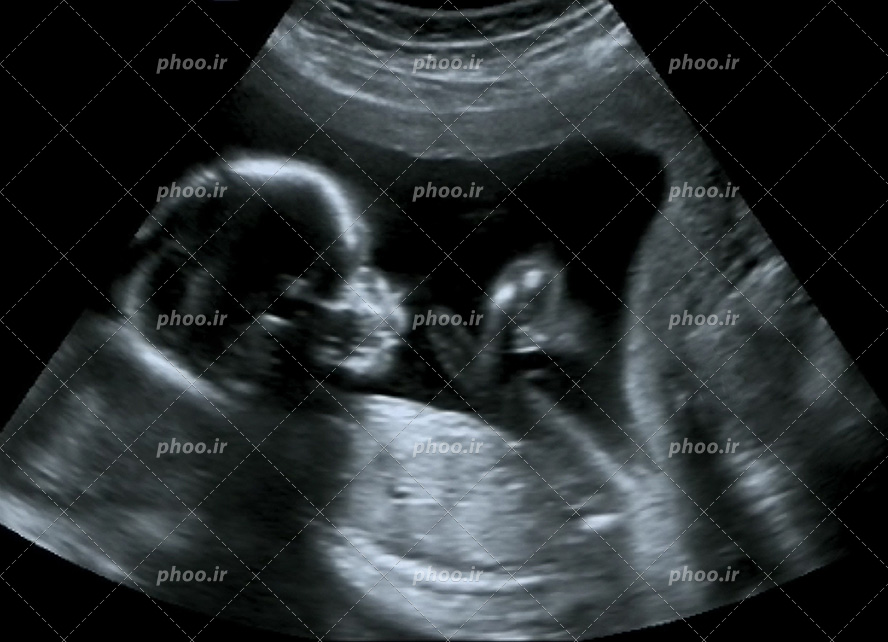 عکس با کیفیت جنین چهار ماهه در سونوگرافی