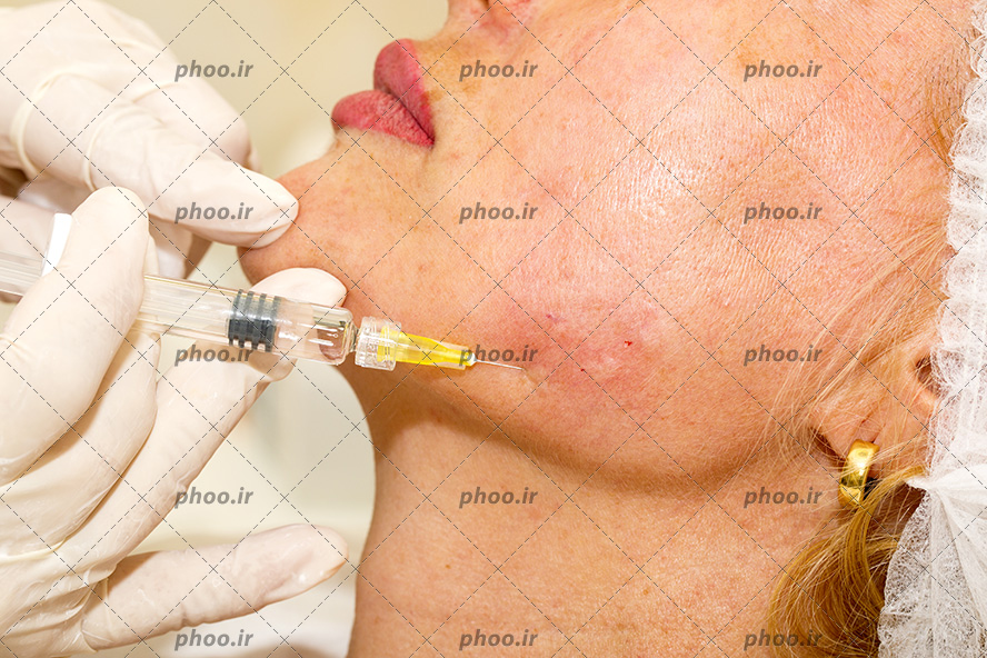 عکس با کیفیت پزشک در حال تزریق ژل و بوتاکس صورت و فک زن