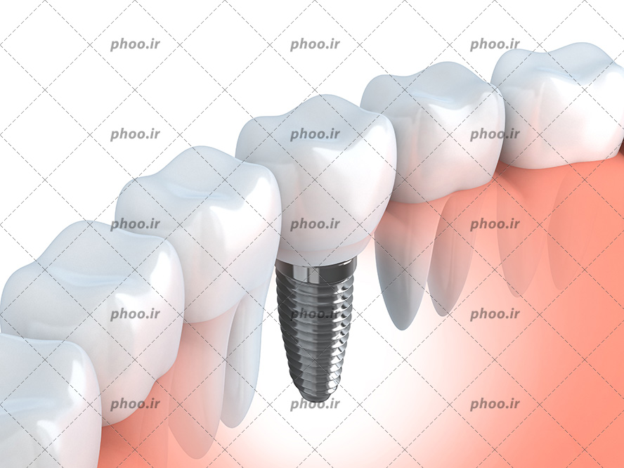 عکس با کیفیت دندان های سفید و منظم در کنار یک دیگر و یکی از دندان ها ایمپلنت شده است