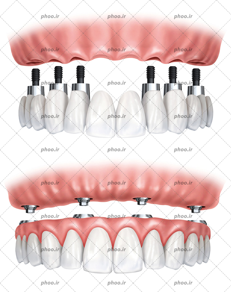عکس با کیفیت مراحل کاشت ایمپلنت دندان در پس زمین سفید