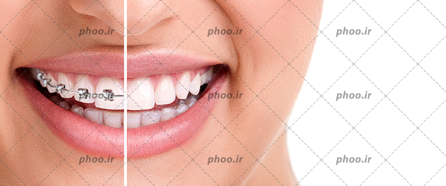عکس با کیفیت زن با لبخند زیبا و نصفی از دندان های او ارتودنسی شده و نصف دیگر بدون ارتودنسی