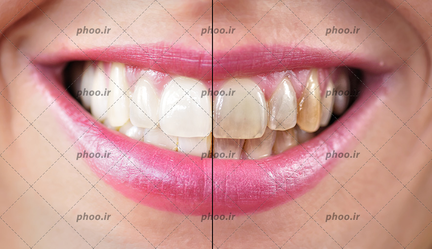 عکس با کیفیت زن با لب های صورتی و نیمی از دندان های زن به رنگ زرد و خراب شده و نیمی دیگر سفید و براق