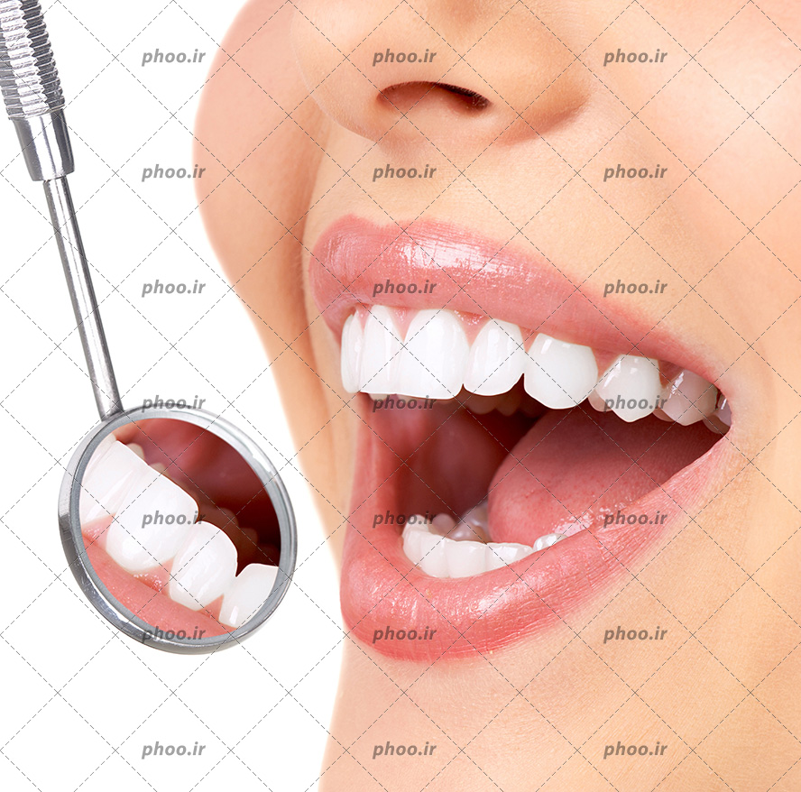 عکس با کیفیت زن با دهان باز و نمایان شدن دندان های سفید براق و در مقابل دندان ها آینه مقعر برای معاینه دندان ها