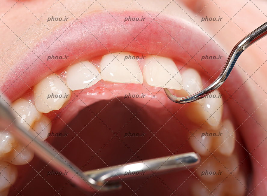عکس با کیفیت آینه مقعر در دهان زن و پزشک در حال معاینه دندان های زن